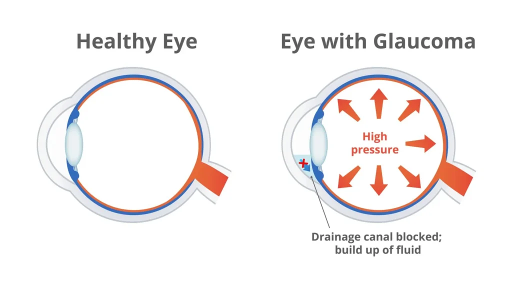 176347972_l-1920w What is Glaucoma?
