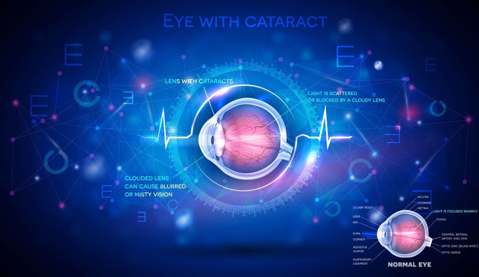 How Long After Cataract Surgery Can You Drive?