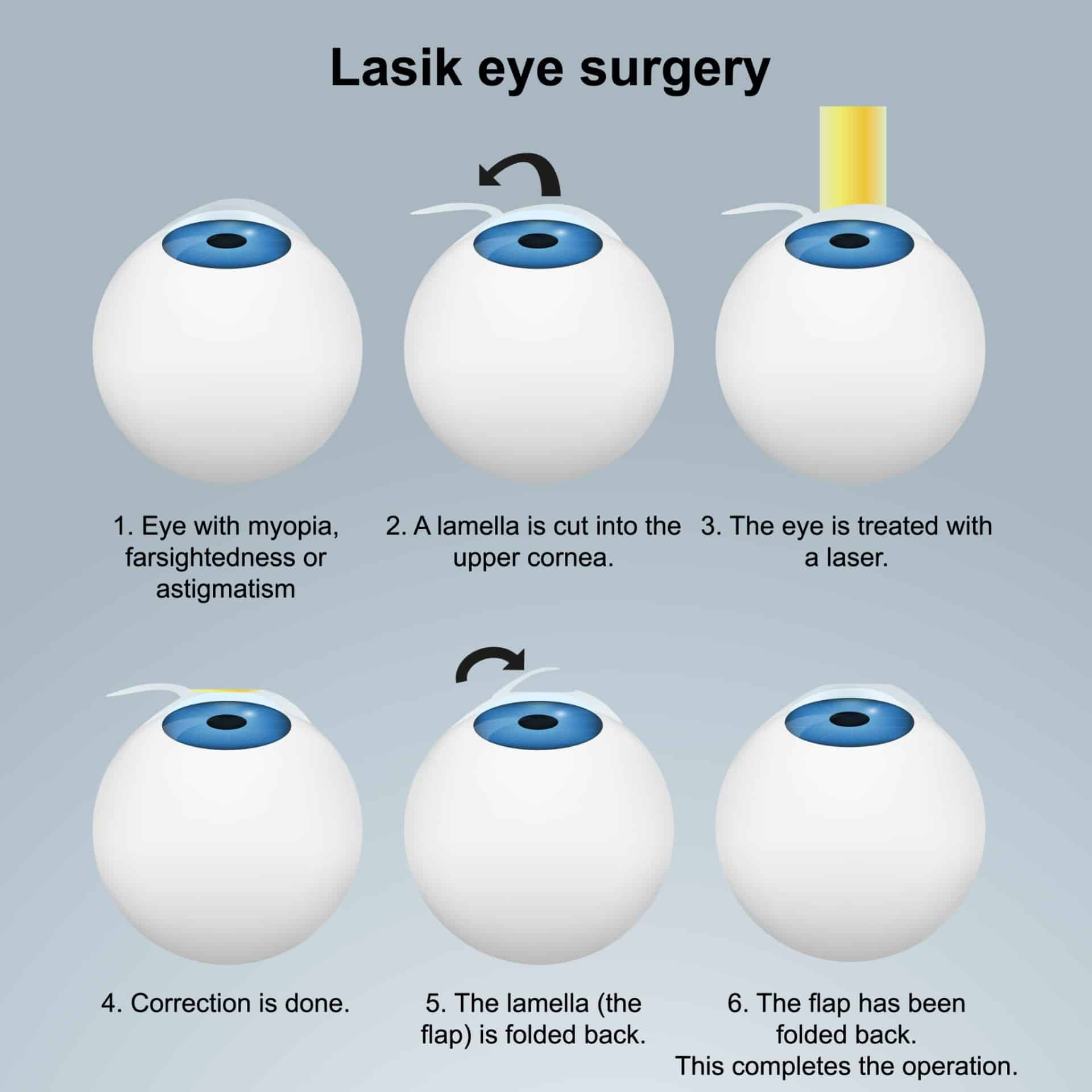 How Long Does LASIK Last?