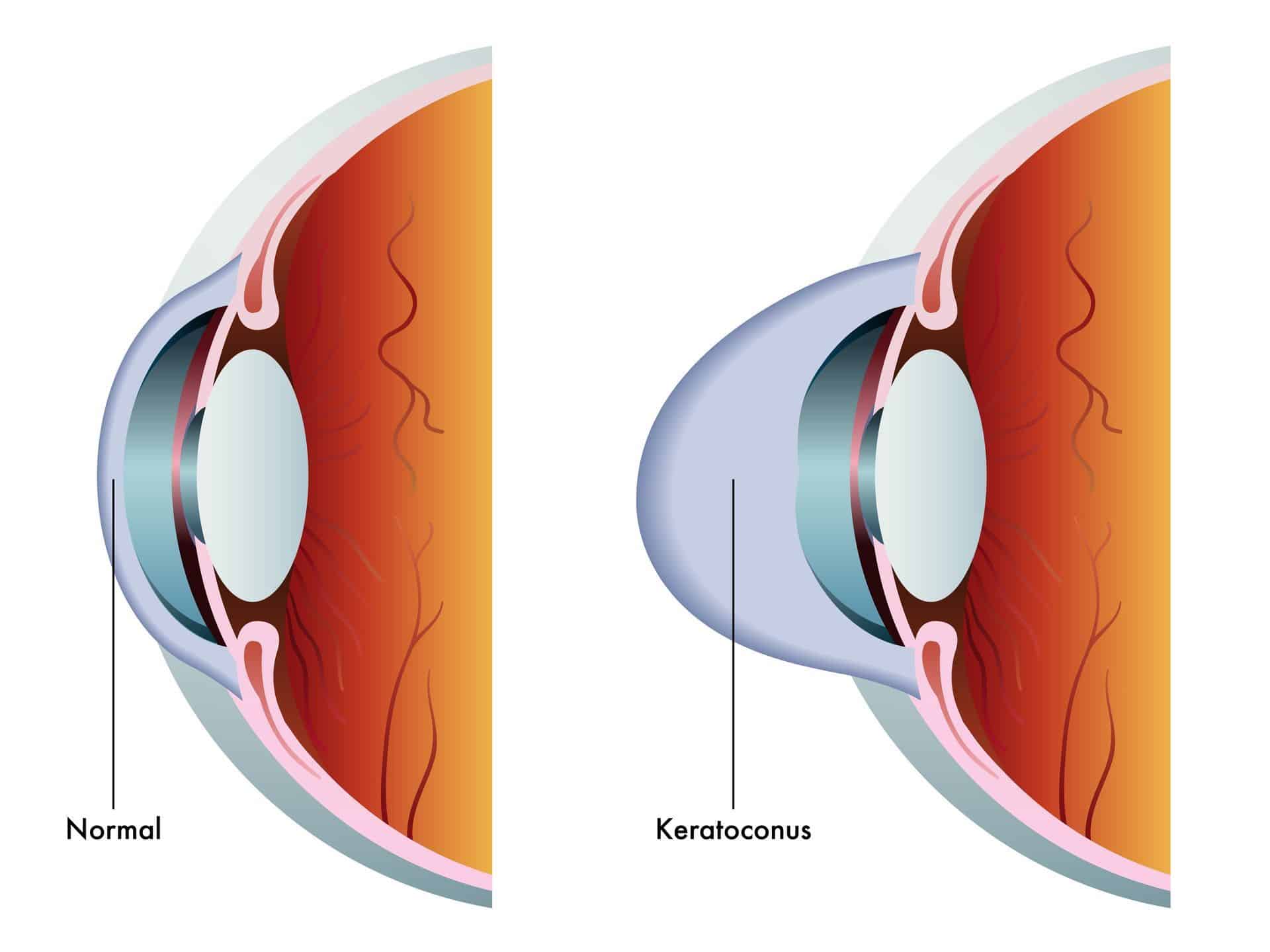 What is Corneal Crosslinking?