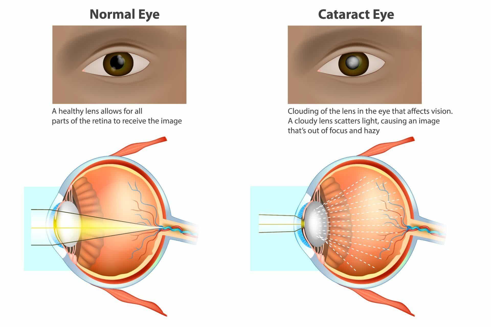 What Is The First Sign Of Cataracts?